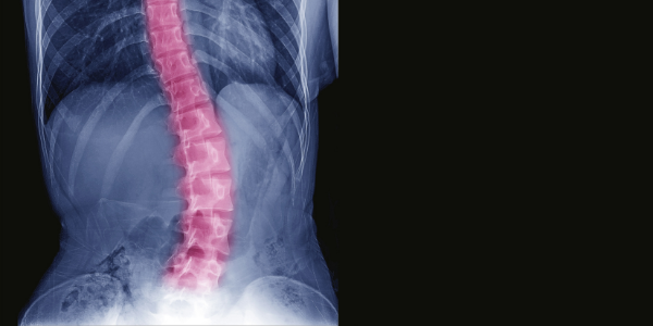 scoliosis